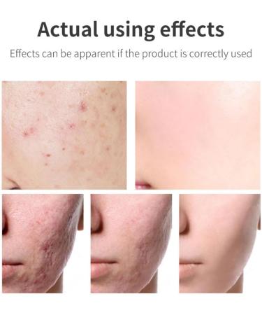 Acne Scar Removal Gel Face Body Marks Skin Repair Cream Acne Treatment Essence 30g acne removal cream - Buy Online on SooperMarket.com