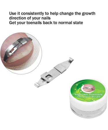 Ingrown Toenail Treatment Stainless Steel Ingrown Toenail Corrector Relief Paronychia Treatment Correcting Tool - Buy Online on SooperMarket.com