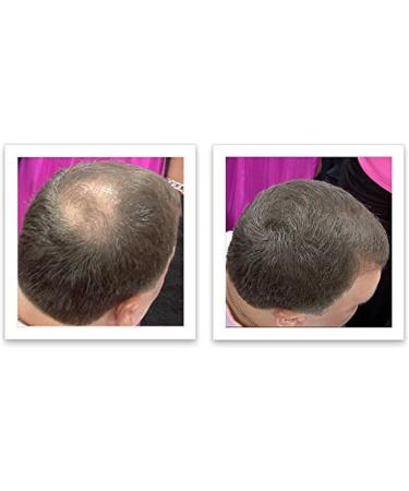 Caboki Hair Loss Concealer Hair Building Fiber 25g (Black) - Buy Online on SooperMarket.com