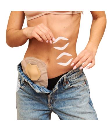 SIIL Ostomy Shield | Stoma Guard | Ostomy Protector Ostomy | Ostomy supplies | Ostomy Bag Cover Beige