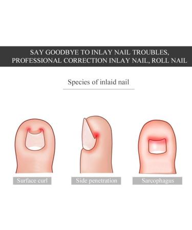 Nail Corrector Pedicure Tool - 12Pcs/Box Toenail Correction Kit for Ingrown Nails - Foot Care Fixer in 6 Sizes - Buy Online on SooperMarket.com