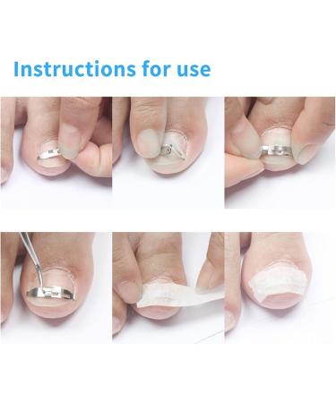 Ingrown Toenail Treatment Stainless Steel Ingrown Toenail Corrector Relief Paronychia Treatment Correcting Tool - Buy Online on SooperMarket.com
