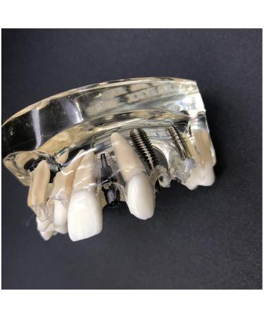 Implant Tooth Template | Oral Simulation Dental Study Model for Teaching - Shop Internationally - Buy Online on SooperMarket.com