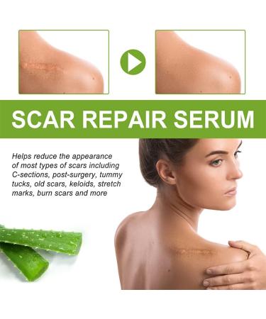 Dajidafu Women Belly Stretch Mark Body Acne Scars Removal Girls Repair Essence Anti-aging Beauty Supplies 30ml - Buy Online on SooperMarket.com