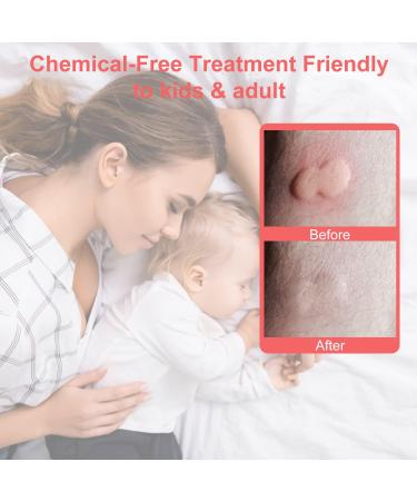 USB Electric Anti-Itch Device for Insect Bite Relief - Pink - Buy Online on SooperMarket.com