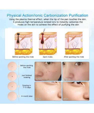 Skin Tag Removal Pen Best Skin Tag Remover Pen 9 Modes LCD Display & Spotlight Portable Rechargeable Skin Tags Removal kit with Replaceable Needles for Wart Freckle Dark Spot - Buy Online on SooperMarket.com