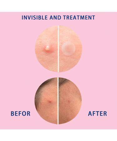 Buy Acne Patches - Invisible Hydrocolloid Spot Stickers for Fast Healing | 108 Translucent Pimple Patches Two Sizes Available - International Shipping - Buy Online on SooperMarket.com