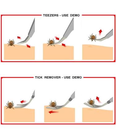 EasyULT 2 in 1 Tick Remover Stainless Steel Professional Tick Removal Tool Safe Tick Remover for Pet Humans Dogs Cats 1 silver - Buy Online on SooperMarket.com