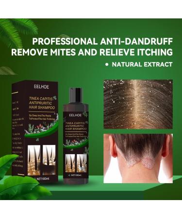 Eczema Psoriasis Anti Dandruff Shampoo for Soothing Dry, Itchy Scalp (200ml) - Buy Online on SooperMarket.com