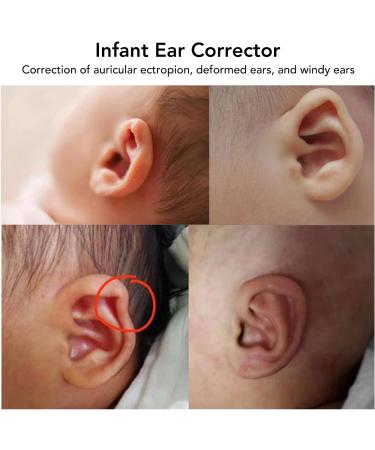 3 PCS Silicone Ear Aesthetic Correctors for Newborns & Children - Fix Ectropion & Deformed Ears - Buy Online on SooperMarket.com