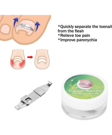 Ingrown Toenail Treatment Stainless Steel Ingrown Toenail Corrector Relief Paronychia Treatment Correcting Tool - Buy Online on SooperMarket.com
