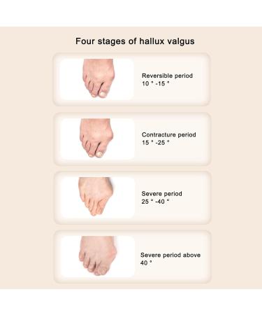 Bunion Valgus Corrector | Adjustable Orthopedic Toe Straightener for Big Toe Joint | Bunion Splint for Hallux Valgus | Green and White - Buy Online on SooperMarket.com