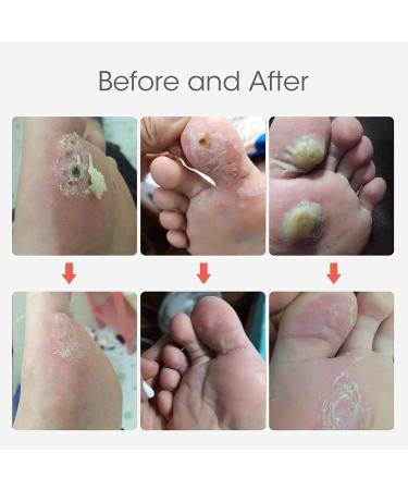 MQUPIN Corn Remover Pads Wart Remover Pads Foot Corn Remover Pads Plantar Wart Removal Corn Callus Remover Penetrates and Removes Common and Plantar Warts with Hole Callus Stops Wart Regrowth (24 PCS) - Buy Online on SooperMarket.com