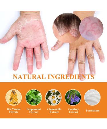 RJDJ Bee Venom Psoriasis Treatment Cream - Professional New Zealand Formula for All Skin Types (5PC) - Buy Online on SooperMarket.com