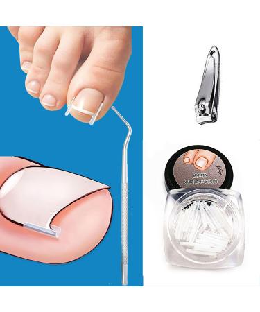 Ingrown Toenail Correction Set - 42 C-Shaped Fill Padding | Simple Tool for Ingrown Toenail Relief - Buy Online on SooperMarket.com