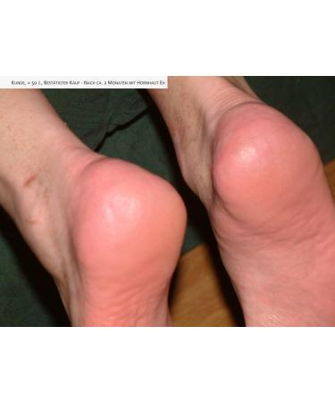 Natural Products Black Callus Ex - Effective Callus Remover & Foot Cream 50ml | Best Foot Care Solution - Buy Online on SooperMarket.com