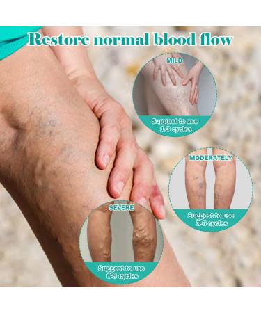 Fengyang 16Pcs Varicose Veins Treatment Patch Set for Legs - Spider Vein Relief, Soothes Leg Fatigue - Buy Online on SooperMarket.com