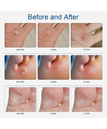 MQUPIN Corn Remover Pads Wart Remover Pads Foot Corn Remover Pads Plantar Wart Removal Corn Callus Remover Penetrates and Removes Common and Plantar Warts with Hole Callus Stops Wart Regrowth (24 PCS) - Buy Online on SooperMarket.com