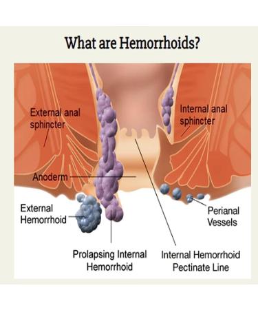 Heca Natural Herbal Hemorrhoid Capsules - 5pcs | Hemorrhoid Relief Treatment Suppositories for Hemeroide Relief, Helps Relieve Discomfort - Buy Online on SooperMarket.com