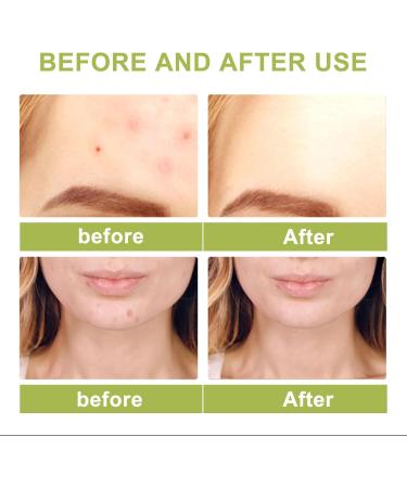 Tea Tree Ance Serum Tea Tree Essential Oils Tea Tree Oil For Skin Anti-Pimples and Acne Moisturizer and Brighten Skin.Tea Tree Oil for Diffuser Humidifier DIY Home Office 100ml - Buy Online on SooperMarket.com