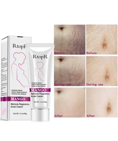 Ofanyia Stretch Mark Removal Cream - Effective Repair for Scars & Pregnancy Marks | International Shipping - Buy Online on SooperMarket.com