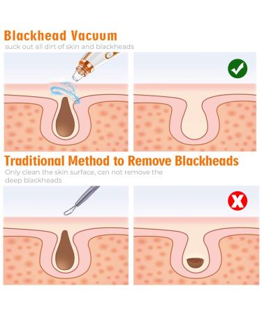 2023 Blackhead Remover Pore Vacuum - Upgraded Electric Facial Cleaner for Acne, Whiteheads - 5 Suction Power, 5 Probes - USB Rechargeable Kit for Women & Men - Buy Online on SooperMarket.com