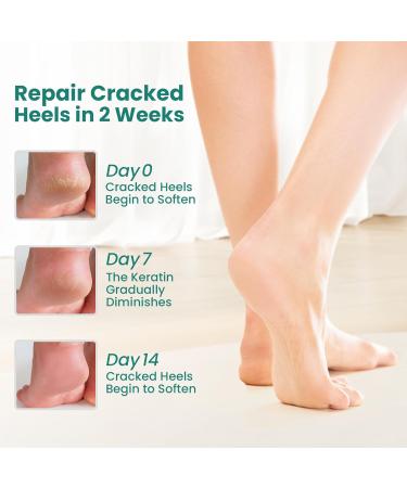 Welnove Moisturizing Heel Socks Aloe Vera Infused Gel for Dry Feet & Cracked Heels 2 Pairs Cotton Foot Care Socks for Men & Women Blue Regular Size - Buy Online on SooperMarket.com