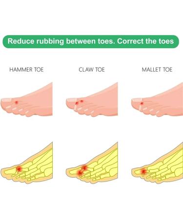 Overlapping Toe Straps for Toe Correction & Finger Fractures - Khaki One Size - Buy Online on SooperMarket.com