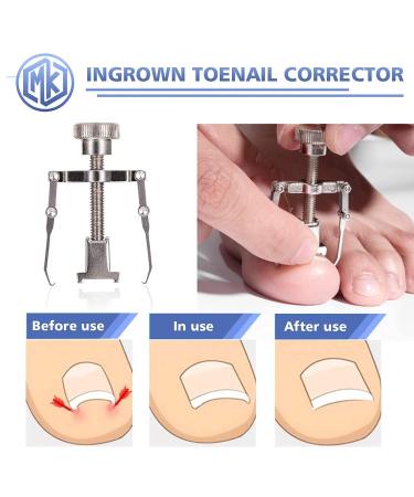 Ingrown Toenail Clippers Kit - Surgical Grade Pedicure Tool for Seniors/Adults - Buy Online on SooperMarket.com