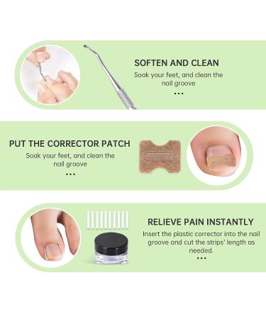 Ingrown Toenail Treatment Kit - 50 Pcs Patches, Corrector Strips, Nail Lifter | Professional & Painless Solution - Buy Online on SooperMarket.com