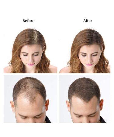 Dark Brown Hair Building Fibers for Thinning Hair, Bald Spots - Keratin Hair Re-growth Powder for Men and Women - Buy Online on SooperMarket.com