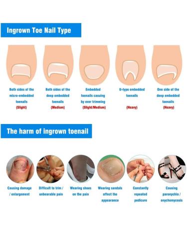 10Pcs/Box Toenail Correction Ingrown Sticker Patch Toe Nail Fixer Recover Pedicure Tool Super Thin Design for Comfort Strong Toughness Effective Corrector Suitable for - Buy Online on SooperMarket.com