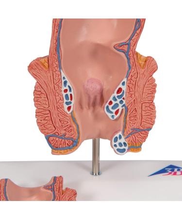 3B Scientific K27 Hemorrhoid Model 5.5-Inchx3.9-Inchx5.5-Inch - Buy Online on SooperMarket.com