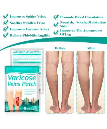 Fengyang 16Pcs Varicose Veins Treatment Patch Set for Legs - Spider Vein Relief, Soothes Leg Fatigue - Buy Online on SooperMarket.com