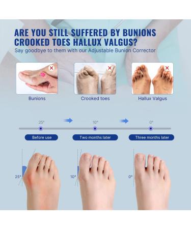 Fit Geno Bunion Corrector for Women Big Toe Adjustable for Men Toe Straightener Bunion Relief Foot Brace Splint Pain Relief Protector Hallux Valgus Corrector(Beige) - Buy Online on SooperMarket.com