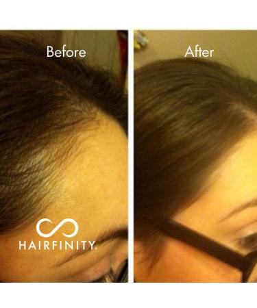 Hairfinity Infinite Edges Hair Serum - Hair Growth Treatment for Alopecia - Stimulates Hair Follicles, Prevents Hair Loss, and Promotes Regrowth - Sulfate & Silicone Free - Buy Online on SooperMarket.com