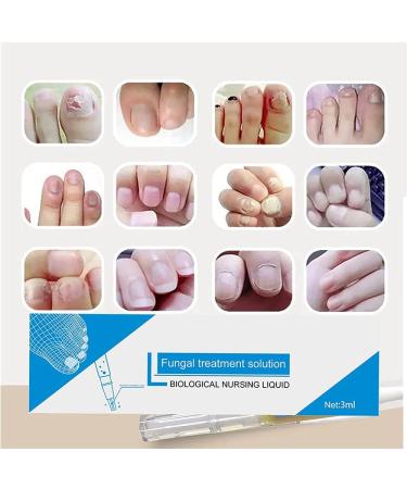 Okita Toenail Fungus Treatment Pen - Effective Nail Repair for Healthy and Strong Nails (5Pcs) - Buy Online on SooperMarket.com