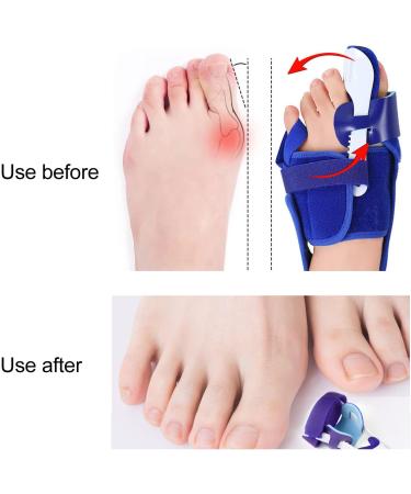 Bunion Toe Splint - Adjustable Strength, Pain-free Movement, Prevents Deviation, Hallux Valgus Support (Left) - Buy Online on SooperMarket.com