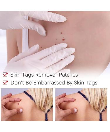 Wipeoff Tags & Moles Remover - Fast & Effective - 2PCS Set - Remove in 5 Days - Safe for All Body Parts - Buy Online on SooperMarket.com