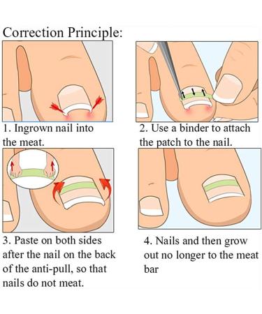 Toenail Tool 6 in 1 Ingrown Toe Nail Fixer Pedicure Toenail Recover Nail Foot Care Kit Ingrown Toenail Corrector for Men Women(24pcs) - Buy Online on SooperMarket.com