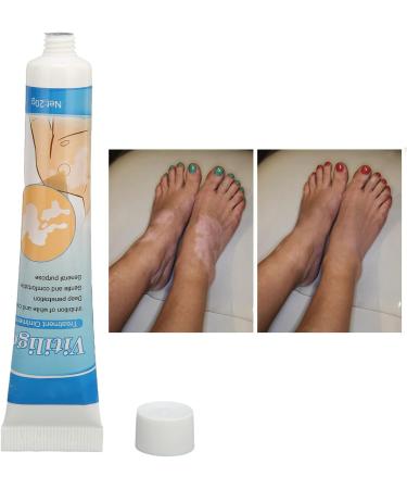 Vitiligo Cream 30G - Herbal Extract Treatment for White Spots & Skin Pigmentation - Creme Medix Leukoplakia Solution - 0.7oz - Buy Online on SooperMarket.com