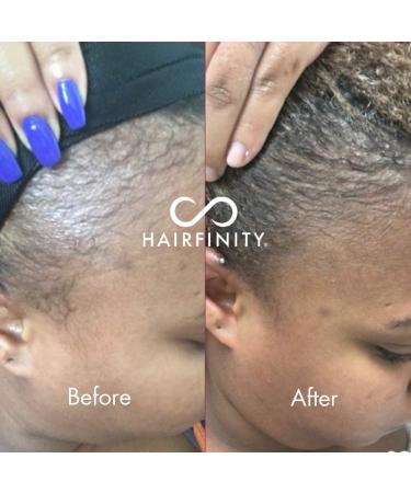 Hairfinity Infinite Edges Hair Serum - Hair Growth Treatment for Alopecia - Stimulates Hair Follicles, Prevents Hair Loss, and Promotes Regrowth - Sulfate & Silicone Free - Buy Online on SooperMarket.com