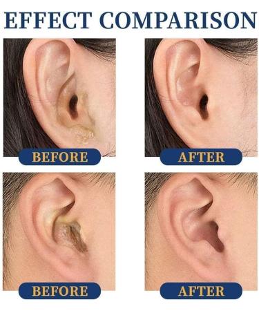 Waitlover 20ml Ear Ringing Relief Drops - Tinnitus & Hearing Care Treatment - Buy Online on SooperMarket.com