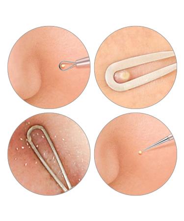 Blackhead Remover Acne Treatment Kit - Professional Skin Care Tools for Pimple Popper, Blemish, and Whitehead Extraction - 5 Piece Stainless Steel Set with Travel Case (Silver) - Buy Online on SooperMarket.com
