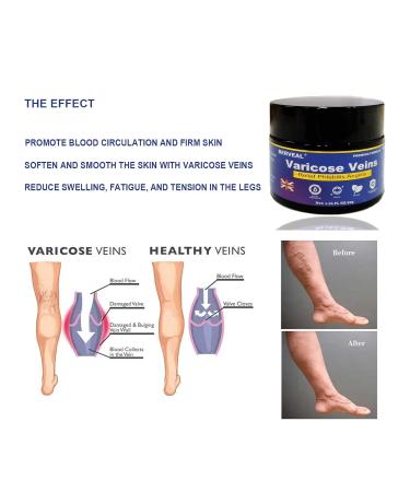 Varicose Veins Cream & Spider Veins Repair - Improve Blood Circulation & Soothe Itching - 1.76 OZ - Buy Online on SooperMarket.com