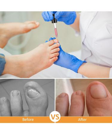 Ingrown Toenail Treatment - Ingrown Toenail Pain Reliever and Softener Kit for Easy Trimming with Silicone Gel Toe Caps Clear - Buy Online on SooperMarket.com