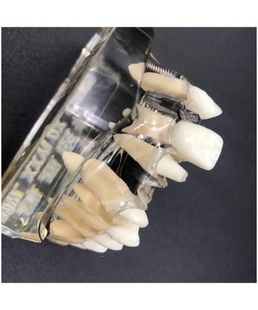 Implant Tooth Template | Oral Simulation Dental Study Model for Teaching - Shop Internationally - Buy Online on SooperMarket.com