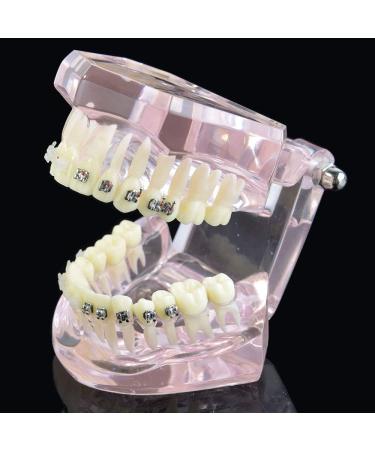LBYLYH Orthodontic Demonstration Model - Teeth Teaching Tools with Metal & Ceramic Support for Effective Dental Treatment - Buy Online on SooperMarket.com