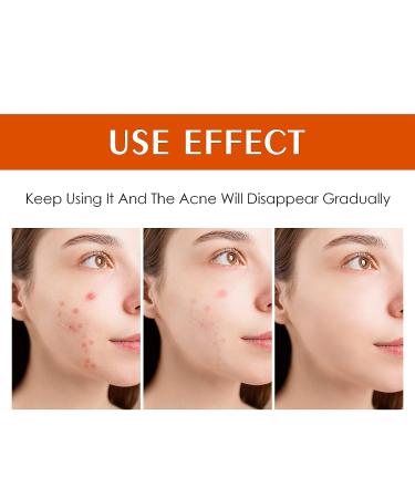 Salicylic Acid Acne Treatment Cream for Face & Body - Teens & Adults | Anti-Acne Moisturizer & Spot Treatment - Buy Online on SooperMarket.com