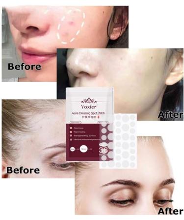 Acne Dressing Spot Patch Acne Paste Transparent Pimple Patch Breathable Painless Acne Treatment Gel Patch Skin Care Absorb Pus Rapid Healing Effective Antibacterial Protection 36 Patches - Buy Online on SooperMarket.com
